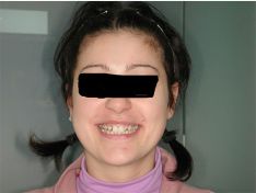 Invisalign e fiori d'arancio